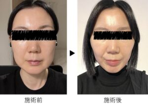 高須クリニック フェイスリフト ブログ