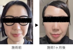 バッカルファット　40代　ブログ