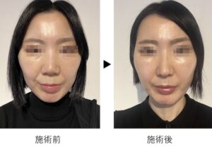 プリモ麻布十番クリニック ブログ 体験談