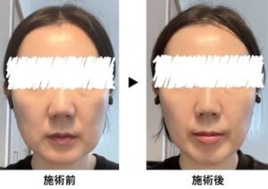 高須クリニック エラボトックス