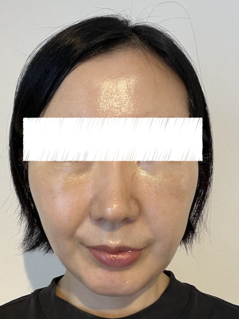 裏ハムラ プリモ麻布十番クリニック 体験ブログ