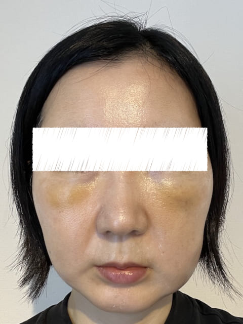 裏ハムラ プリモ麻布十番クリニック 体験 ブログ