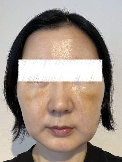 裏ハムラ プリモ麻布十番クリニック 体験談
