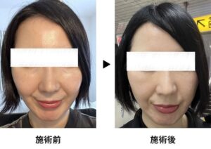 裏ハムラ 体験談