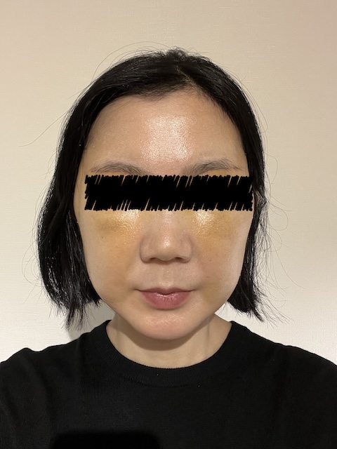 術後7日目の様子