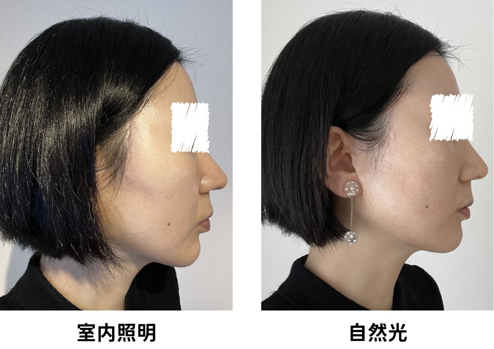 フェイスリフト術後1年の傷跡の見え方が室内照明と自然光で異なる様子