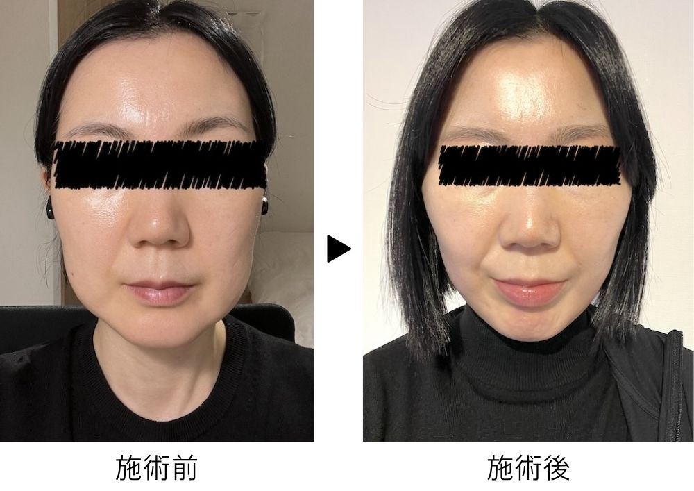 高須クリニックでフェイスリフトを受けた40代女性のビフォーアフター写真